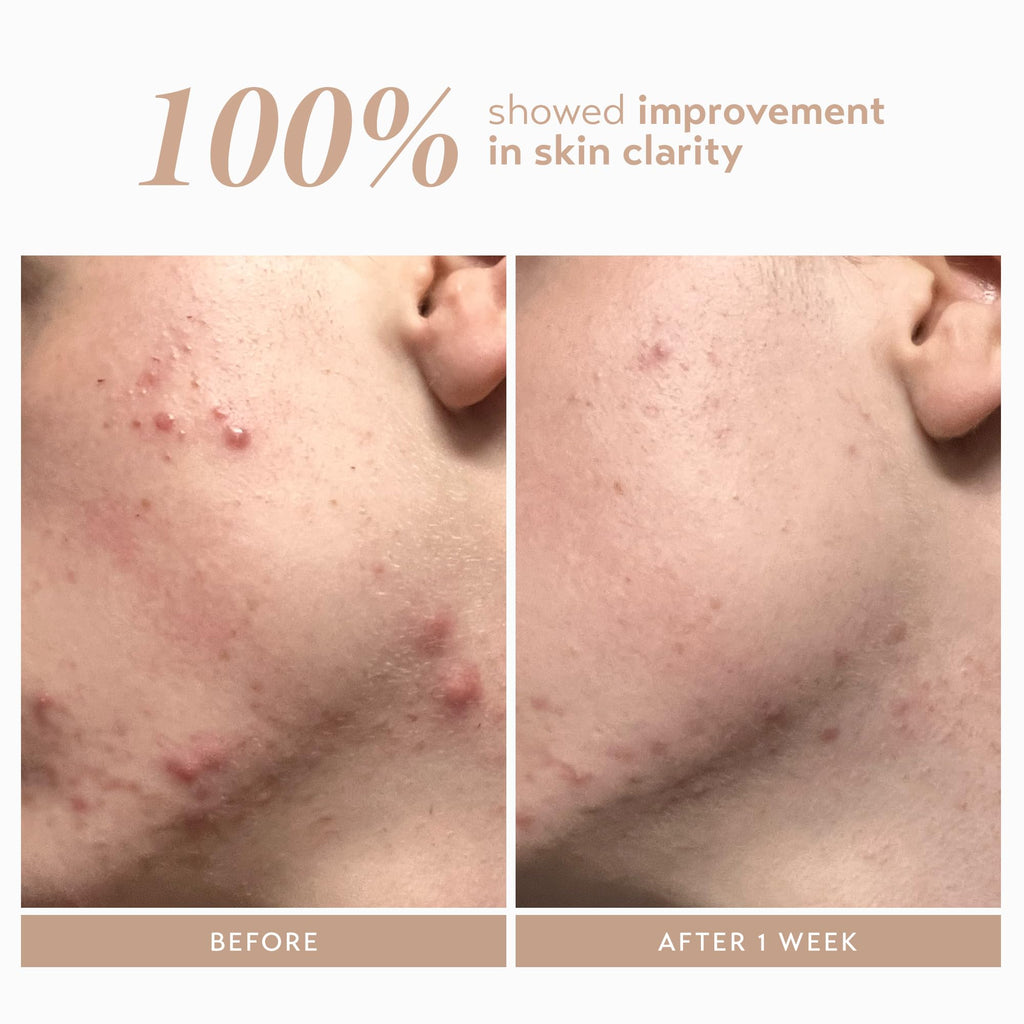 Shani Darden Rescue Serum with 10% Azelaic Complex | Lightweight Hydration