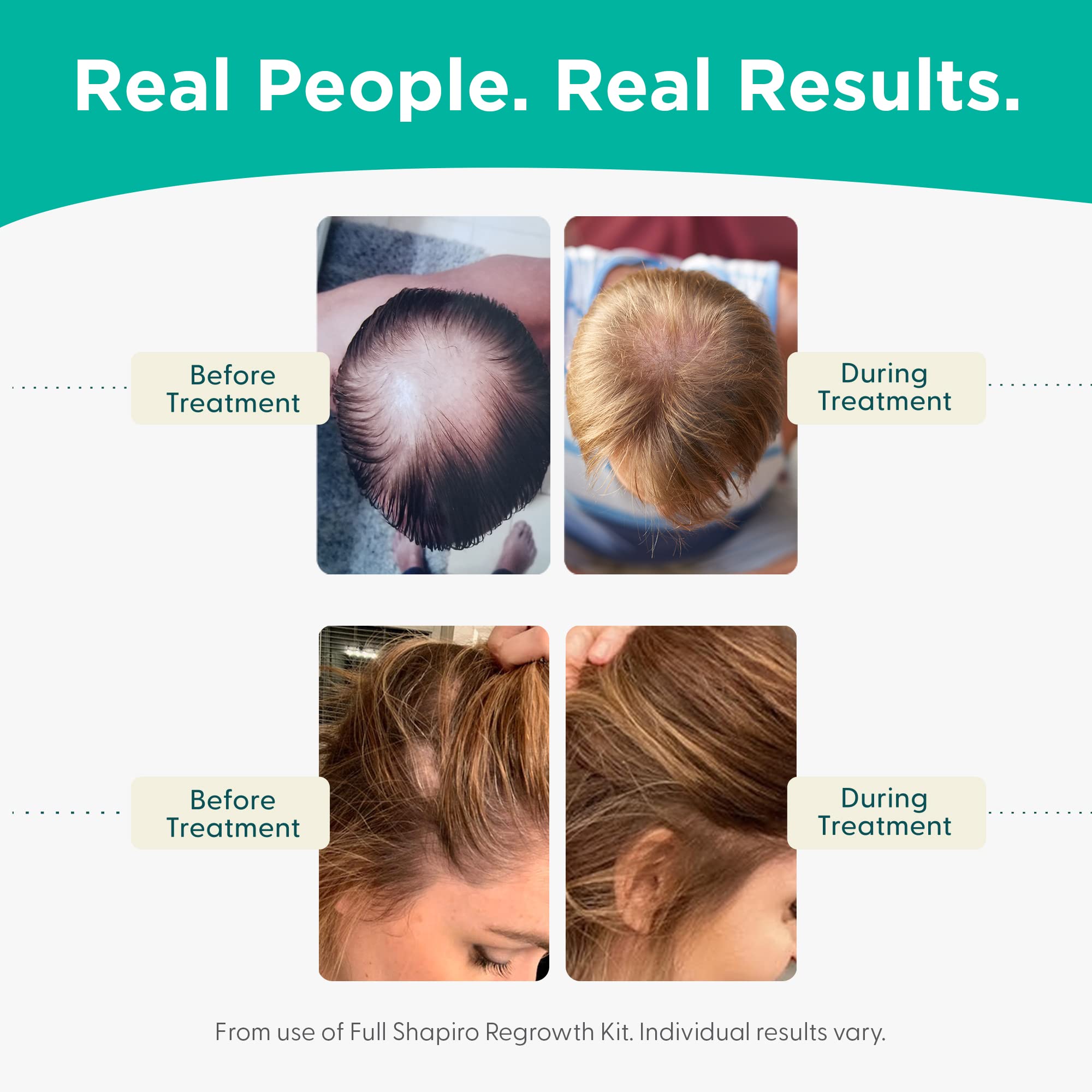 Shapiro MD Leave-In Daily Foam – DHT-Fighting Vegan Hair Growth Solution