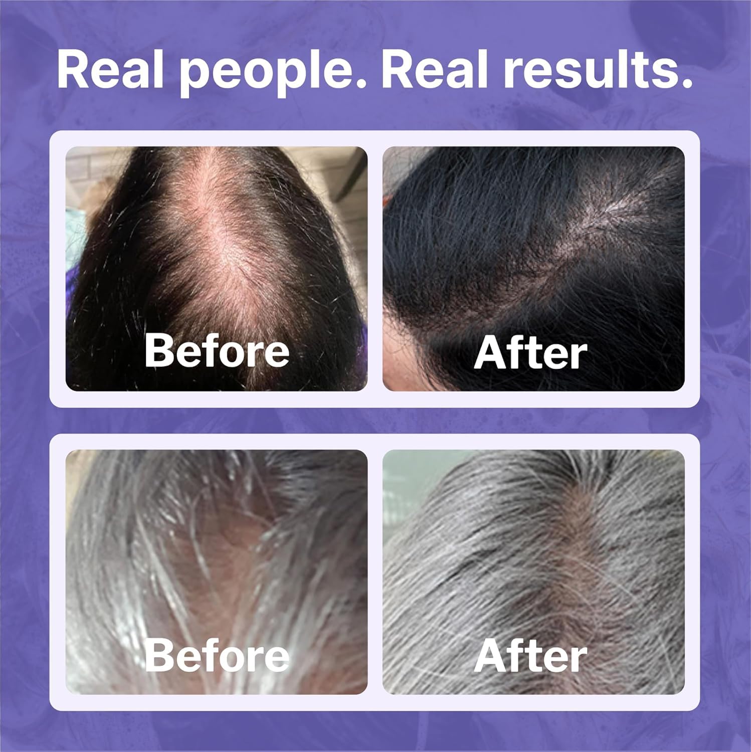 Shapiro MD Hair Growth Experts Womens Travel Kit — Leave-In Foamer & 2% Minoxidil