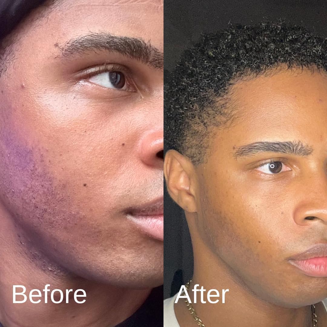 Shield Acne System for Men and Boys – Face Wash, Moisturizer & Pimple Patches (2 Months)