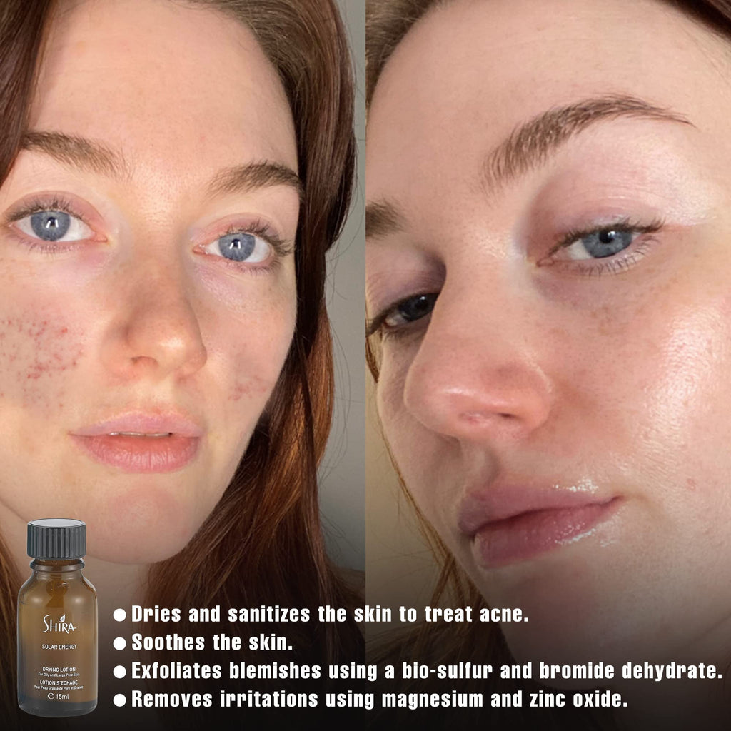 Shira Solar Energy Drying Lotion for Acne & Oily Skin - 15ml