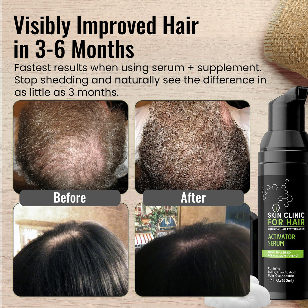 Botanical Hair Loss Foaming Serum by Skin Clinic for Hair — Saw Palmetto & Plant-Based Density Support