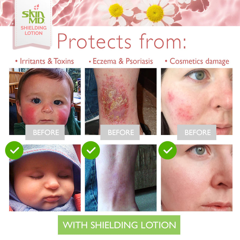 Skin MD Shielding for Face & Body | Hypoallergenic Moisturizer (8 oz)