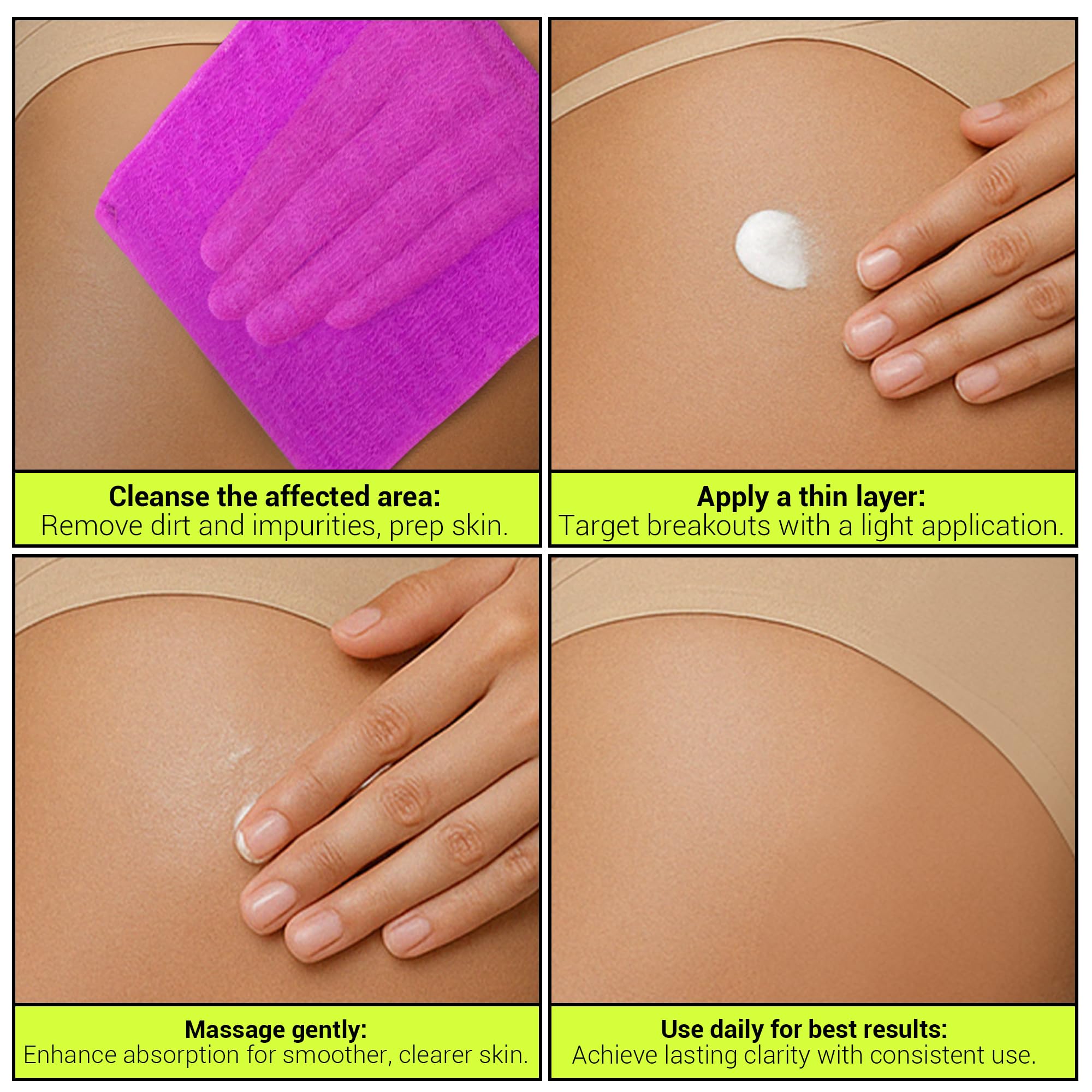 SKINBOSS Butt Acne Clearing Treatment – Hydrating Body Lotion for Back, Bum & Thighs (5 oz)
