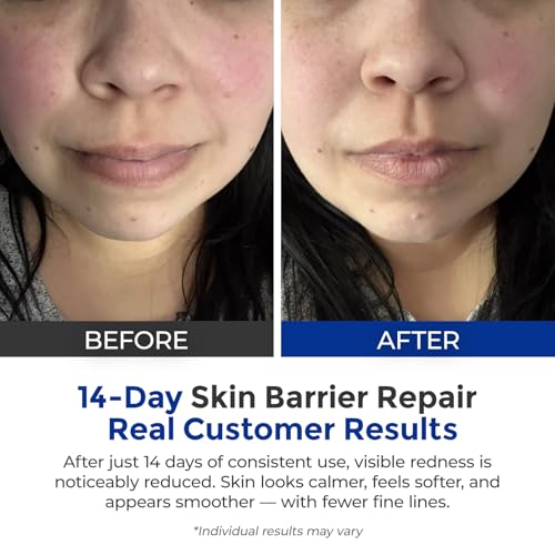 SKINERSE Intensive Repair Serum — 15% Hyaluronic Acid for Sensitive Skin