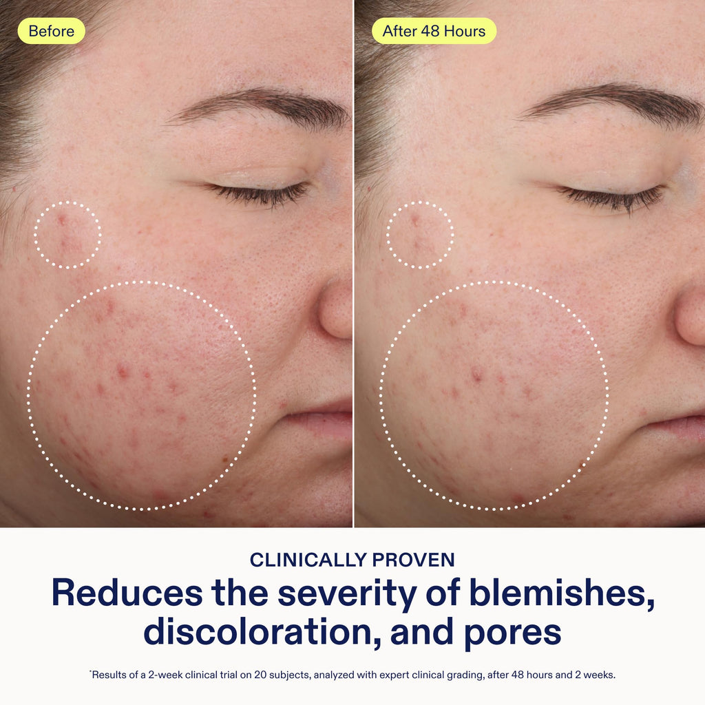 Skinfix 2% BHA Cleanser - Fragrance-Free Acne Care for All Skin Types (5 oz) | Vegan & Cruelty-Free