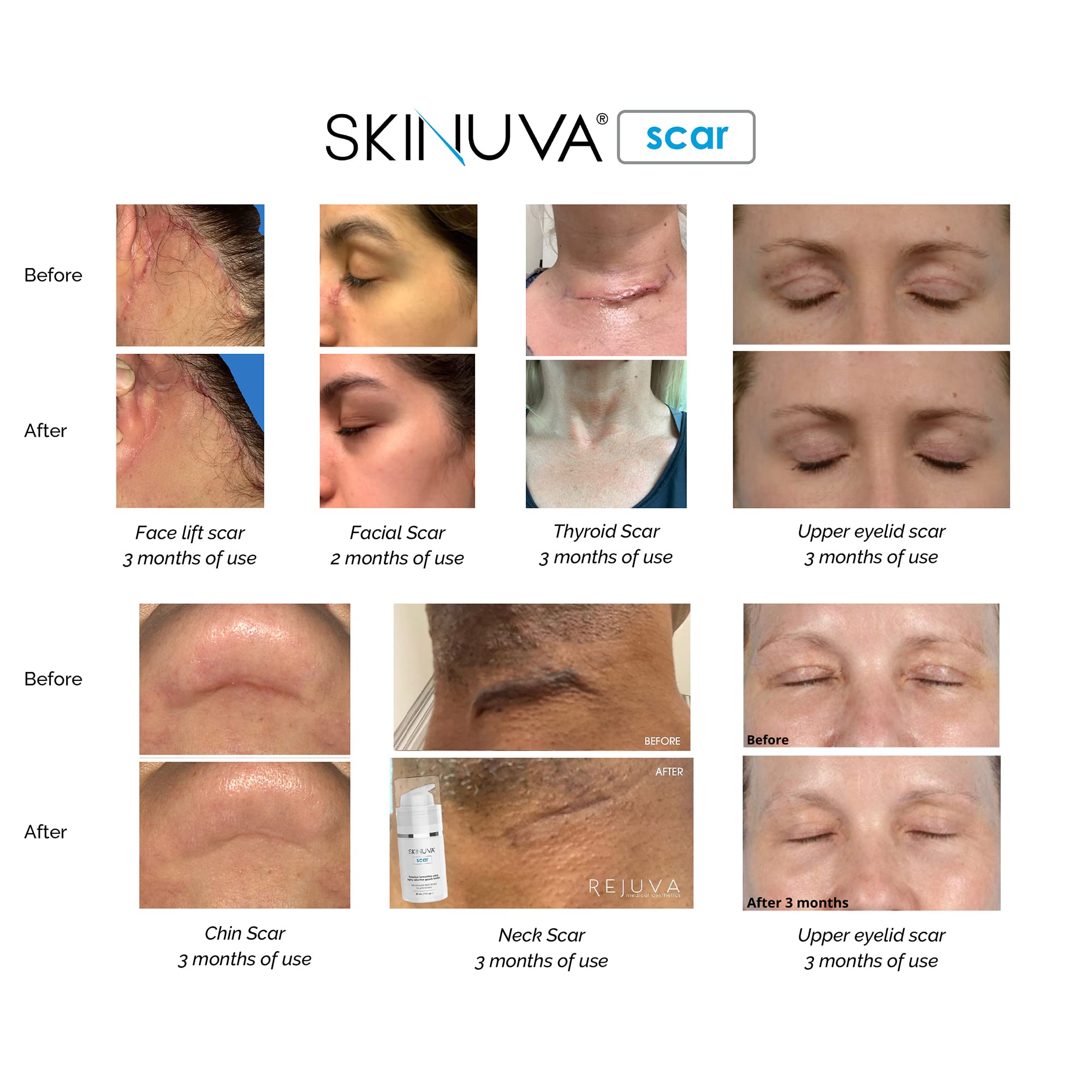 Skinuva Next Generation Scar Cream | Growth Factors, Hyaluronic Acid & Vitamin C (2.5 oz)