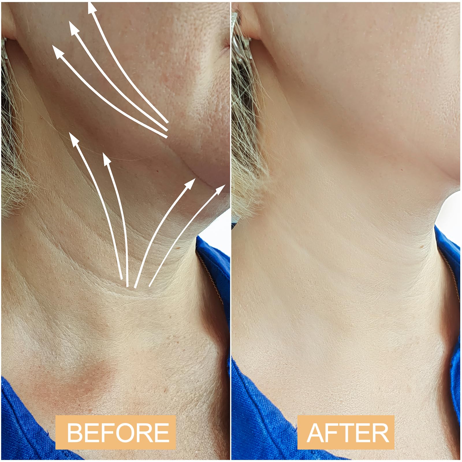 Snifflink Neck Lifting Tape – Instant Lift for Sagging Skin & Double Chin (Beige)