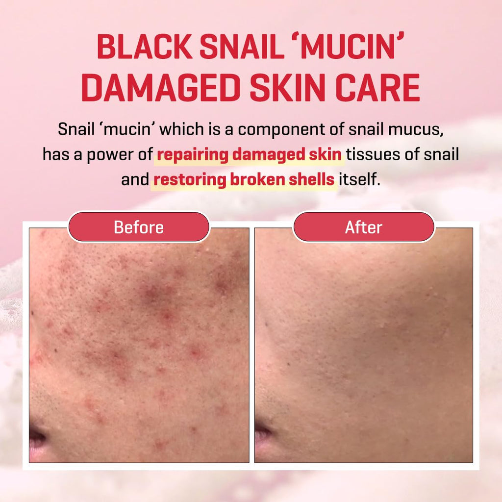 SOME BY MI Snail Trucica Miracle Repair Serum – 50ml for Sensitive Skin & Post-Acne Support | Korean Skincare