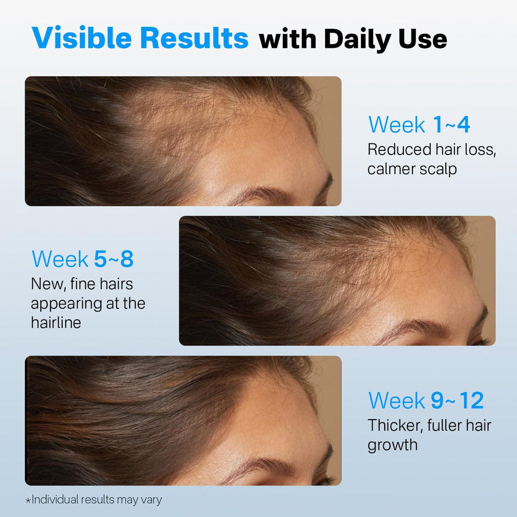 SORNBEO Hair Growth Serum Roll-On – Rosemary & Saw Palmetto, Non-Greasy Scalp Serum, 0.84 fl oz