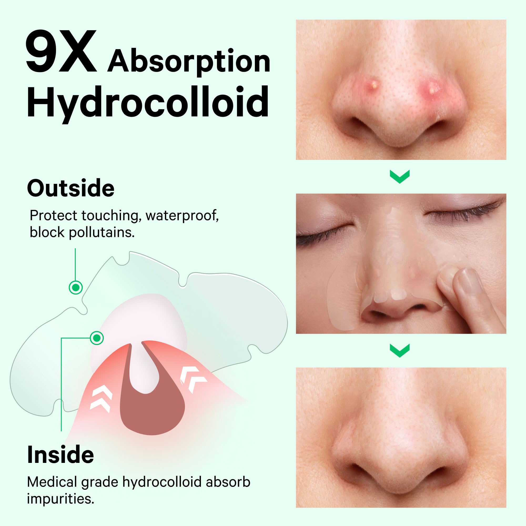 Sosky Nose Patches | Hydrocolloid Pore Strips for Clearer Skin, 14 Count | FSA Eligible Acne Patches