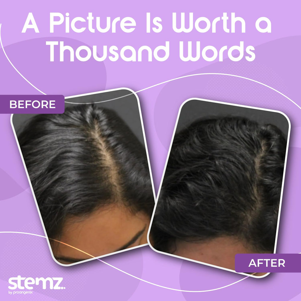 Stemz for Women by Proangenix – Natural Hair Follicle Stimulator