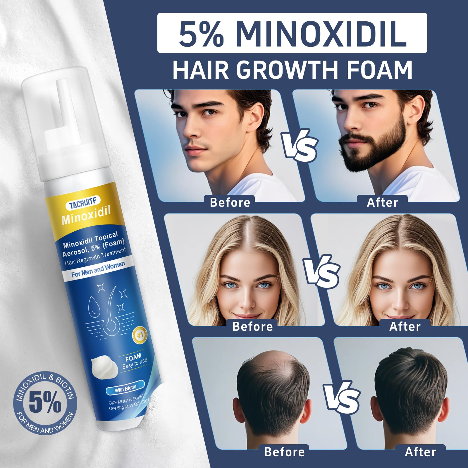 Tacruitf 4-Pack Minoxidil Foam 5% – Hair & Beard Growth, Biotin-Infused, 8.44 oz