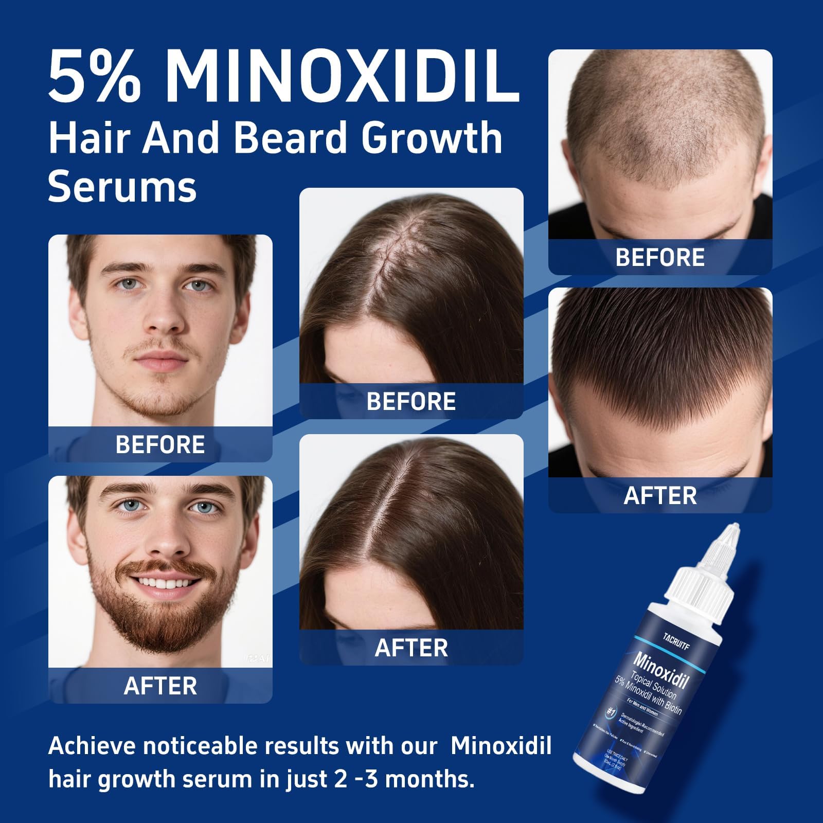 Tacruitf 5% Minoxidil with Biotin – Hair & Beard Growth Solution (6-Pack, 12 fl oz)