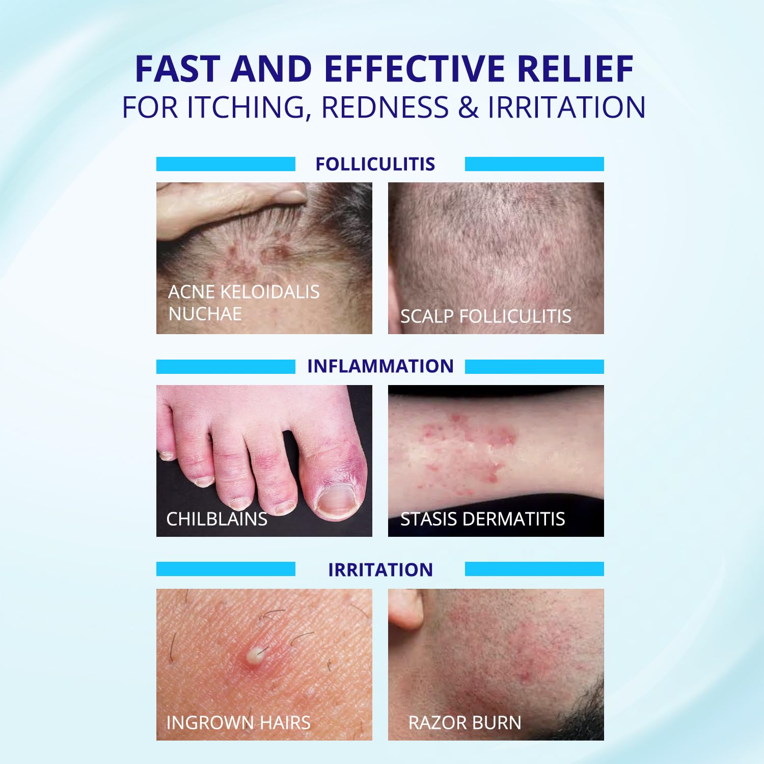 TAGRID Folliculitis Cream – Soothing Ingrown Hair & Hydration (100g)