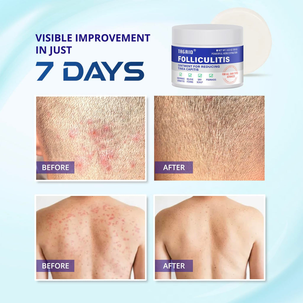 TAGRID Folliculitis Cream – Soothing Ingrown Hair & Hydration (100g)