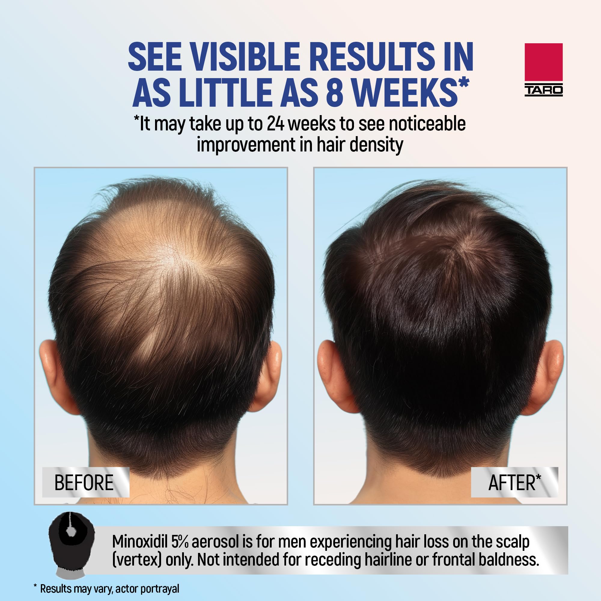 TARO Minoxidil 5% Foam for Men — 3-Month Hair Regrowth Treatment (2.11 oz) 3-Pack