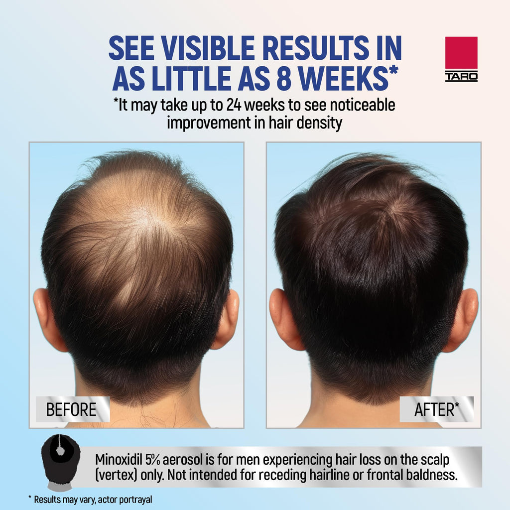 TARO Minoxidil 5% Foam for Men – 2.11 Oz Topical Hair Regrowth Solution (1 Month Supply)