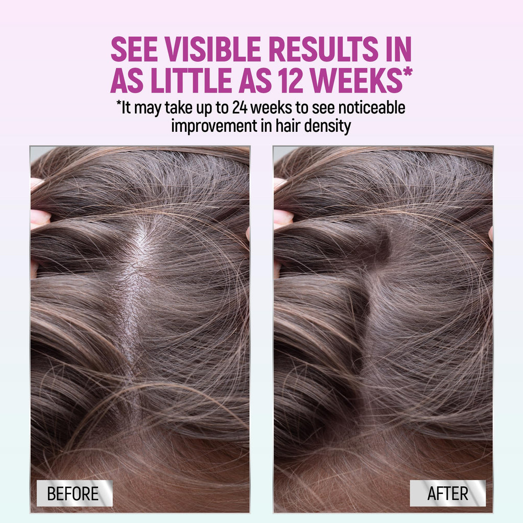 TARO Minoxidil for Women 5% Foam – 2.11 Oz (2 Months) Hair Regrowth Treatment