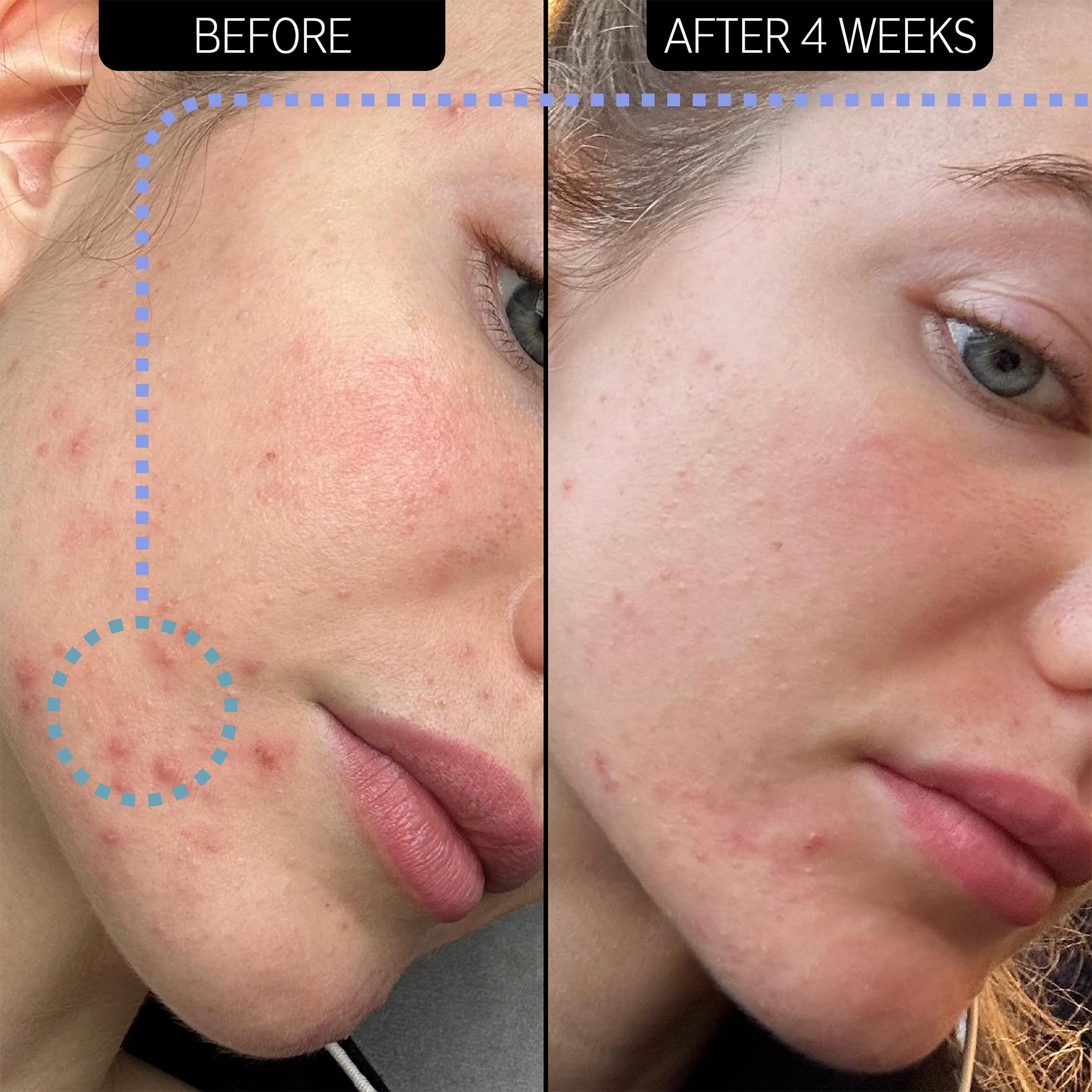 The INKEY List SuperSolutions Novoretin 2% Moisturizer – Nighttime Skin Clearing