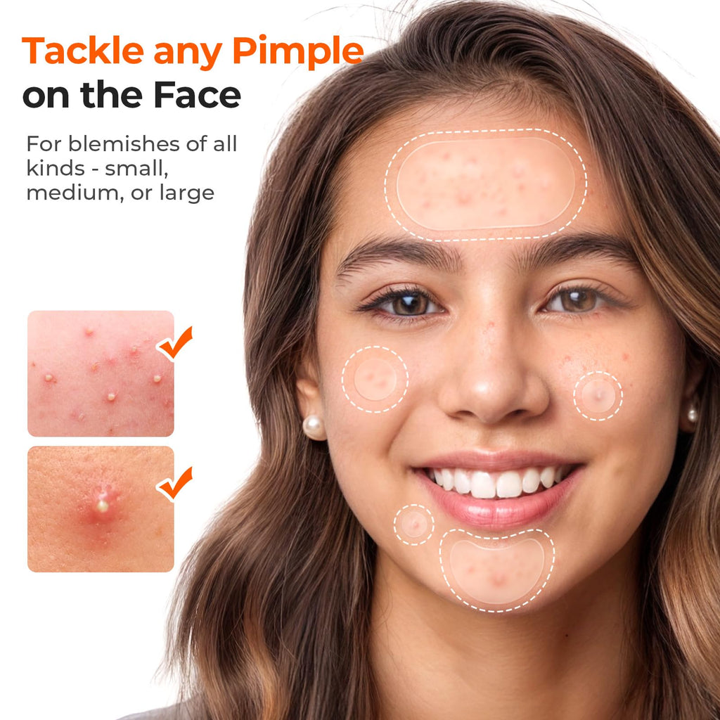TKTK 609-Count Pimple Patches for Face | Hydrocolloid Acne Patches Bulk