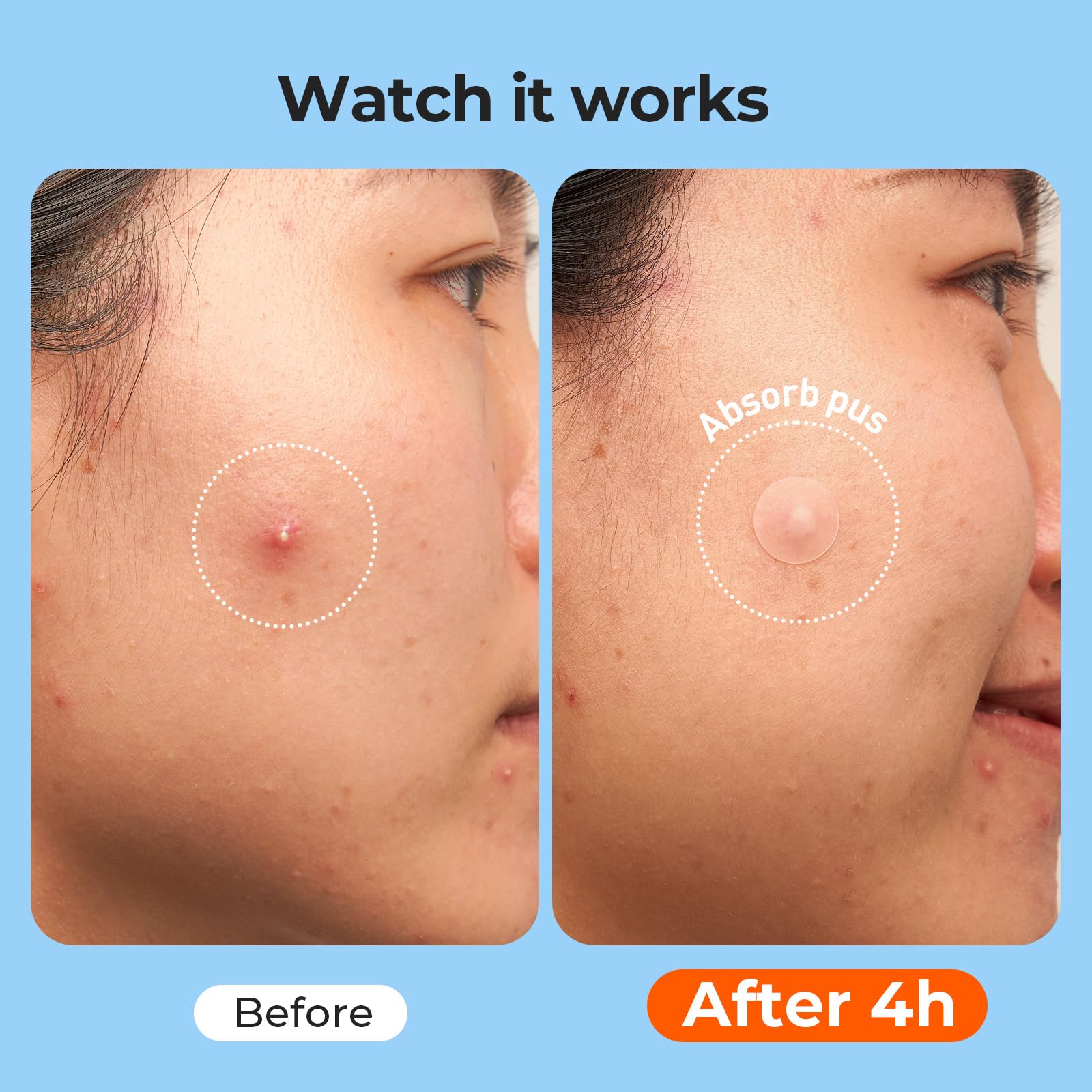 TKTK 609-Count Pimple Patches for Face | Hydrocolloid Acne Patches Bulk