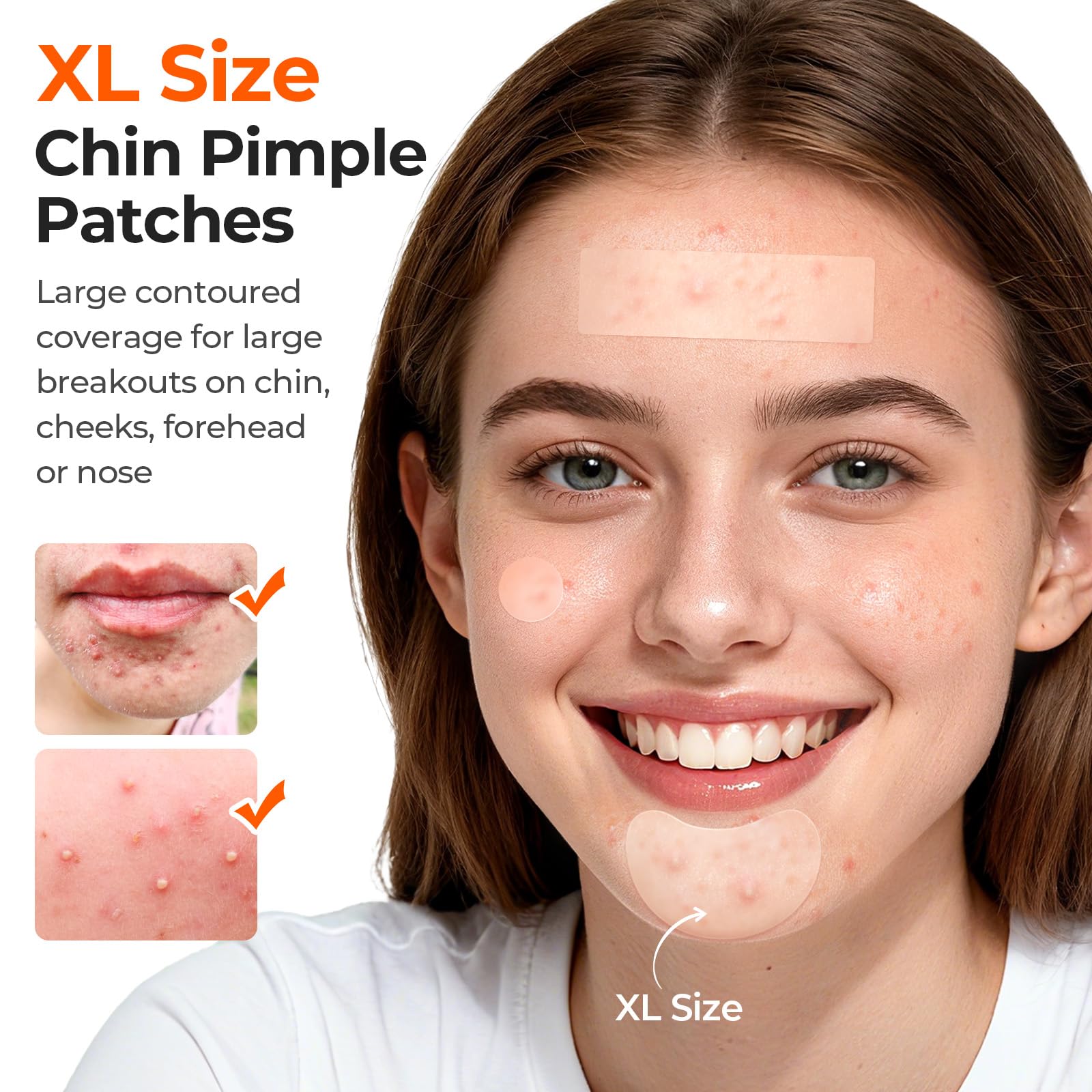 TKTK Large Hydrocolloid Chin Patches – 136 Count, 5 Sizes, Contoured Acne Patches