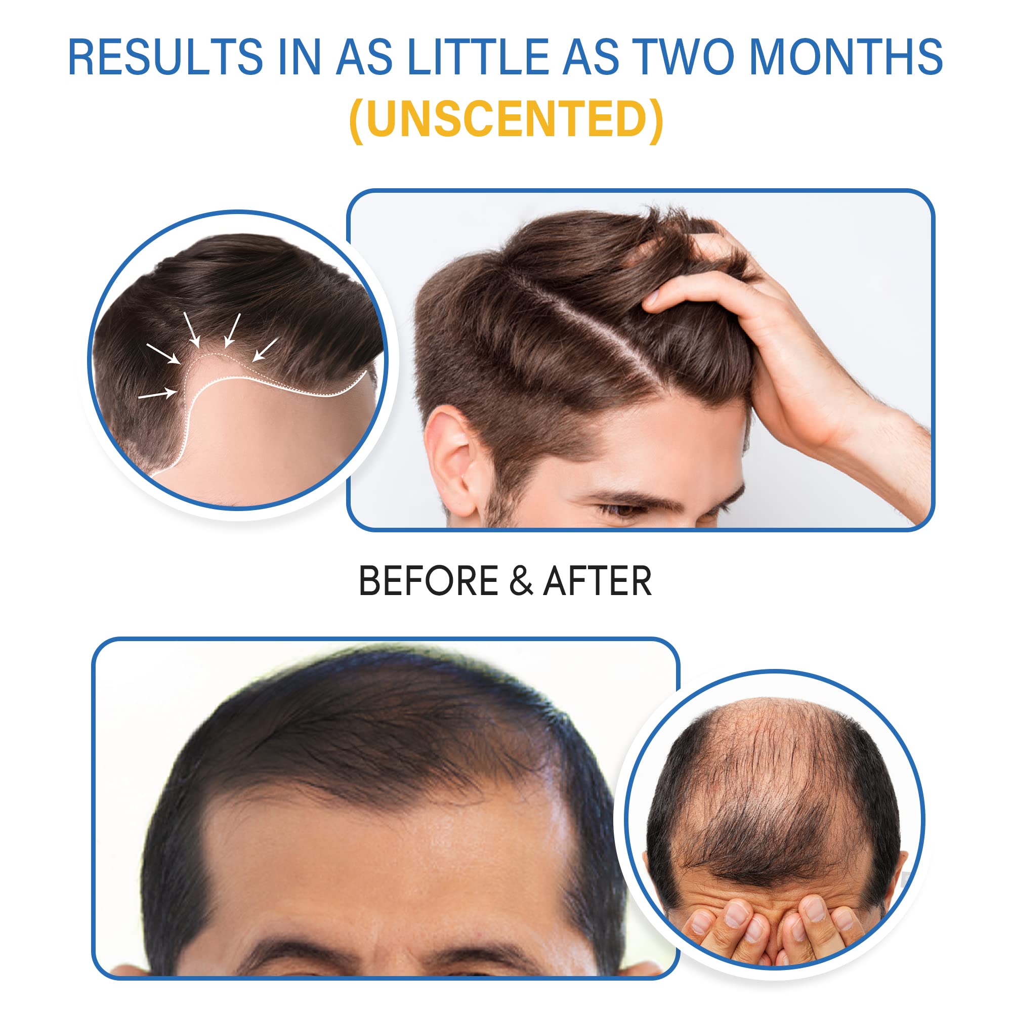 TOMUM 5% Minoxidil Foam for Men & Women – Fast-Absorbing Hair Regrowth