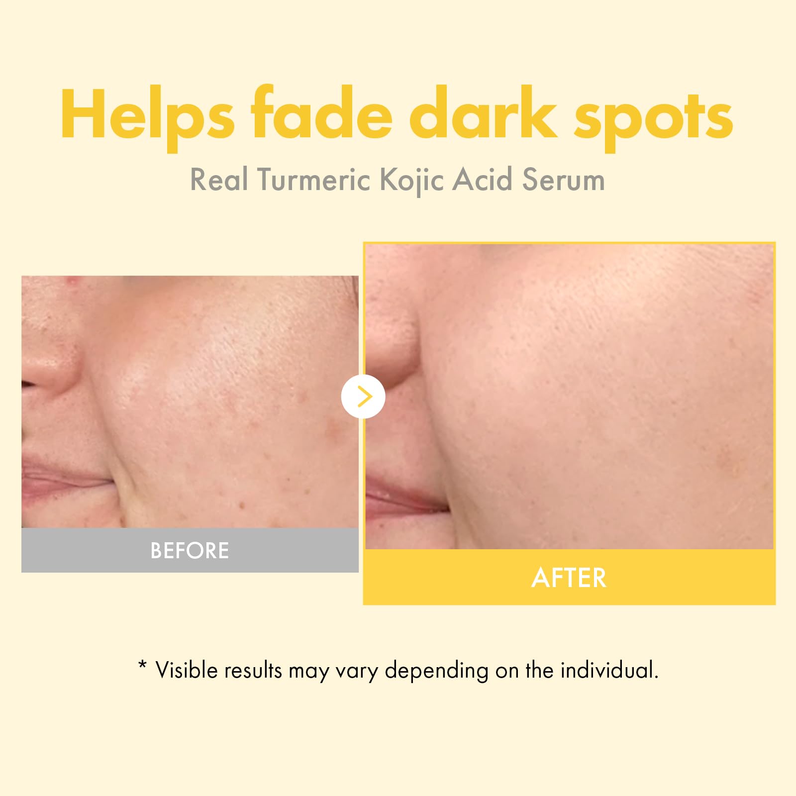 TOSOWOONG Real Turmeric Kojic Acid Serum – Brightening Serum with 7,000ppm Kojic Acid, 1,500ppm Turmeric, 33ml