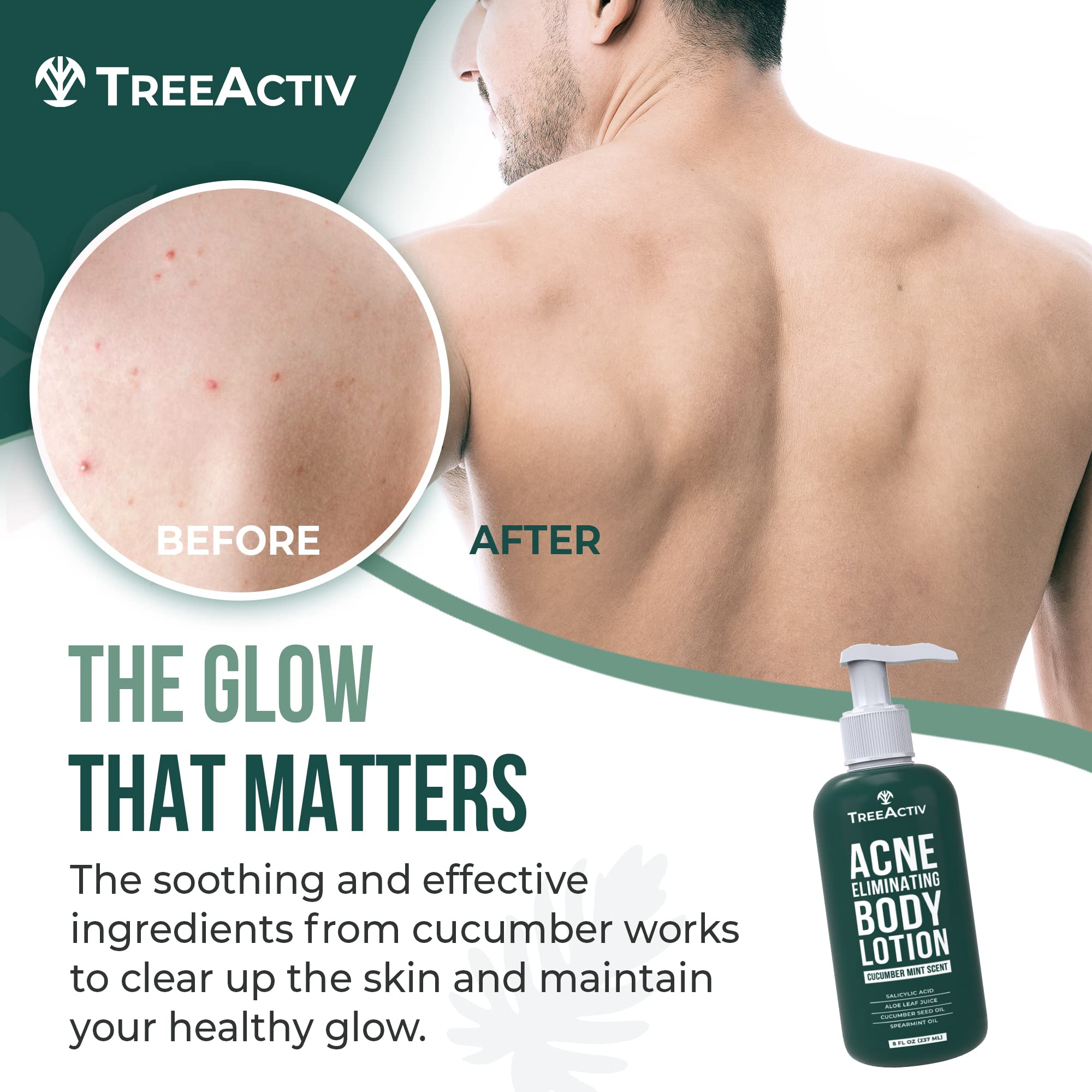 TreeActiv Acne Eliminating Body Lotion 8 oz | Clears Body, Back, Butt & Shoulders | Cucumber Mint