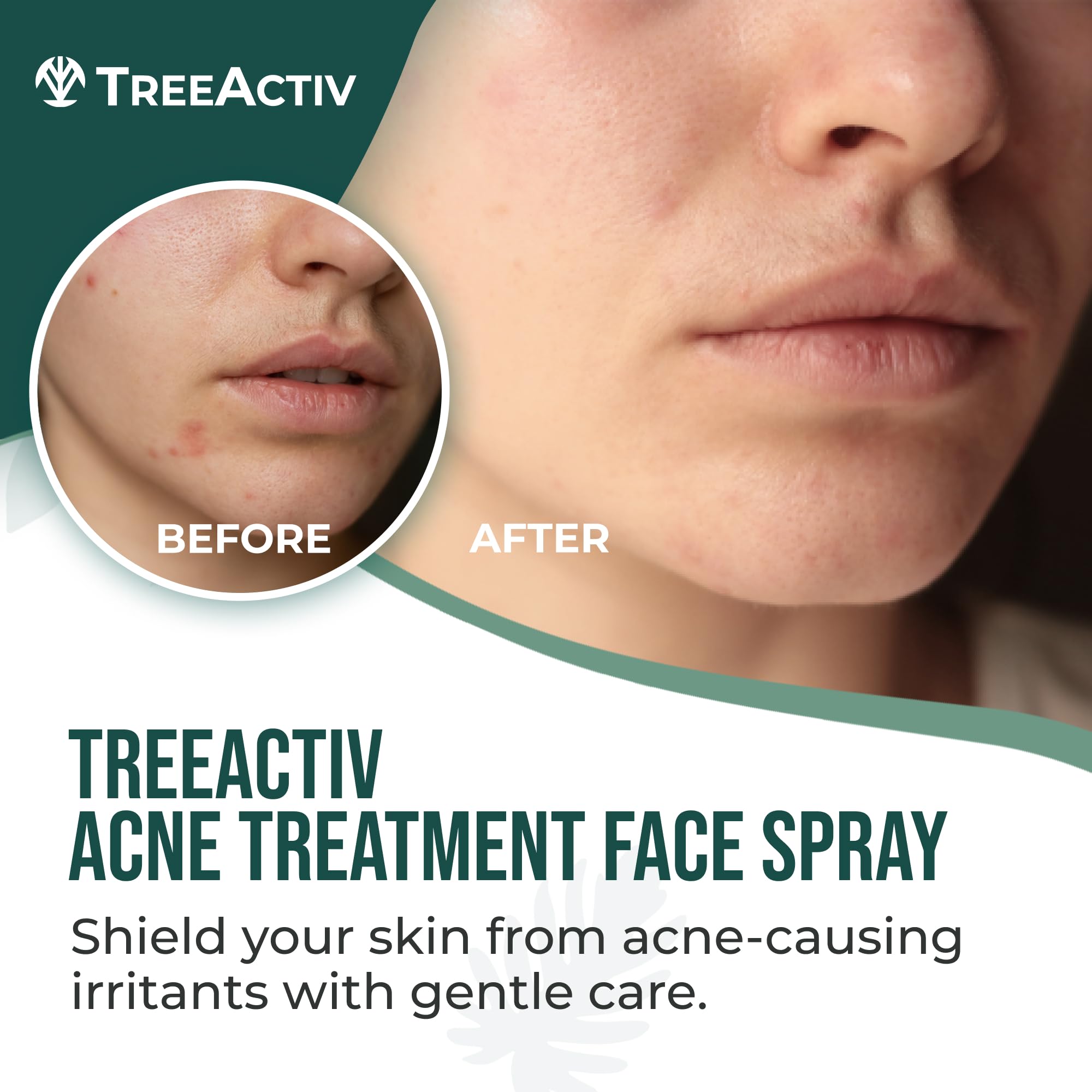 TreeActiv Acne Face Spray — 4 oz Toner with Witch Hazel & Salicylic Acid