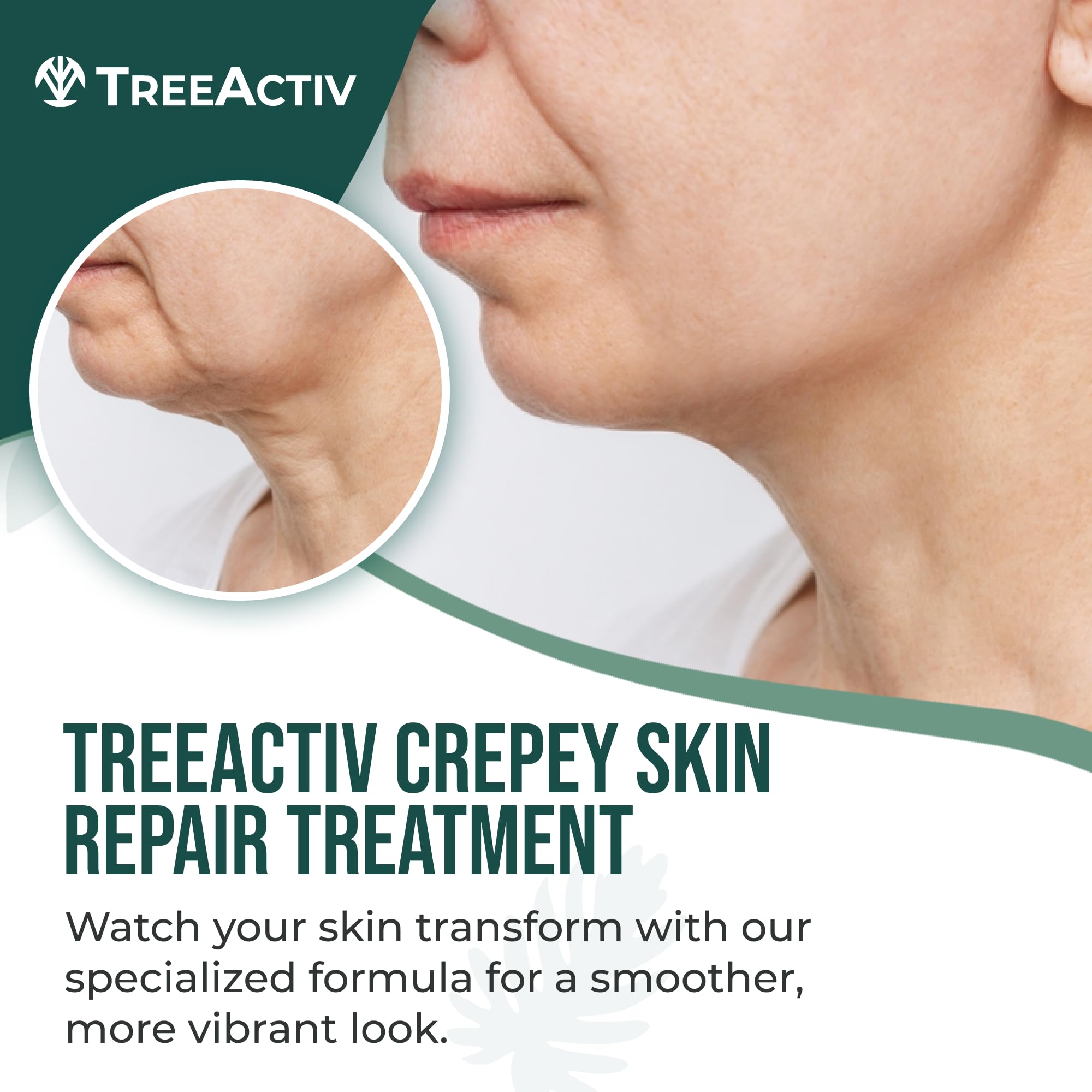 TreeActiv Crepey Skin Repair Cream – Hyaluronic Acid & Shea Butter, 8 oz