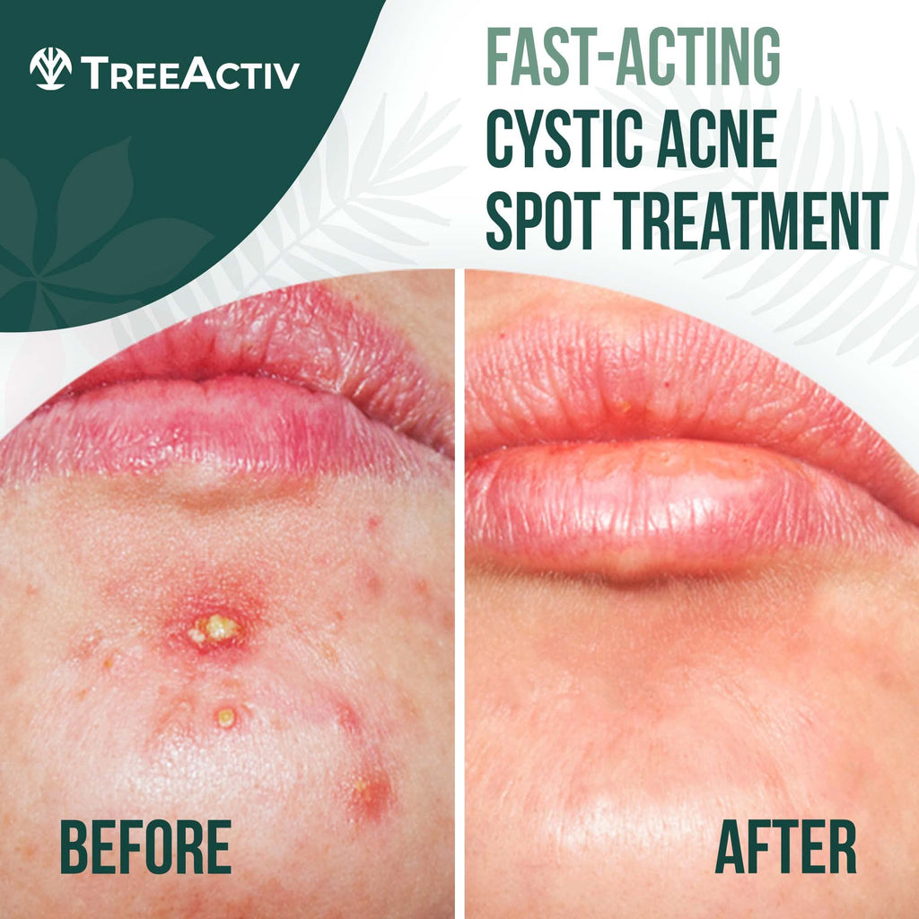 TreeActiv Cystic Acne Spot Treatment – Overnight Sulfur & Bentonite Clay for Face & Body • 0.5oz