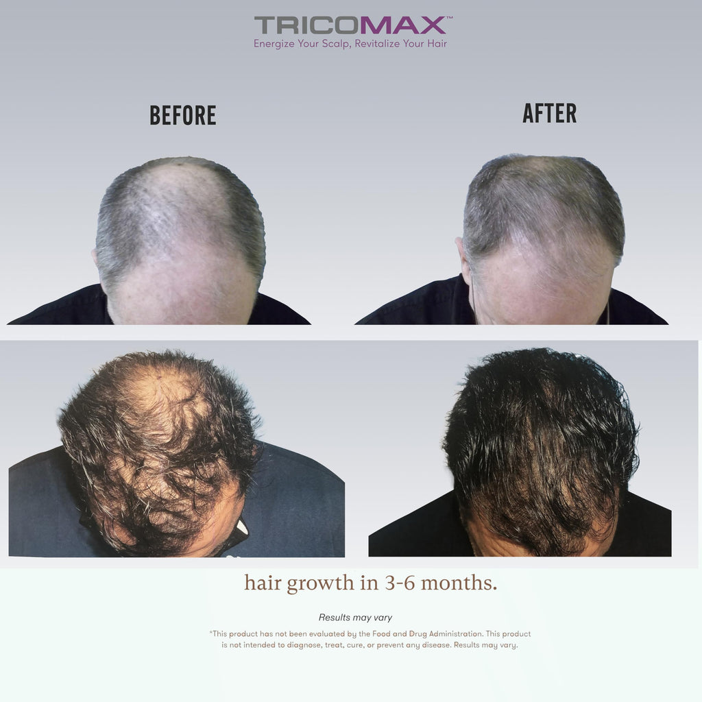 Tricomax Hair Growth Vitamins for Women & Men – Biotin & Saw Palmetto