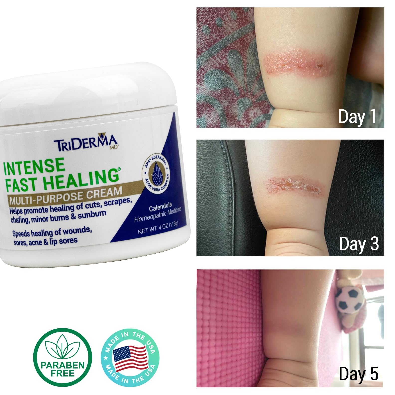 TriDerma Intense Fast Healing Cream – 4 oz for Minor Irritations, Rashes, Scrapes & Cuts