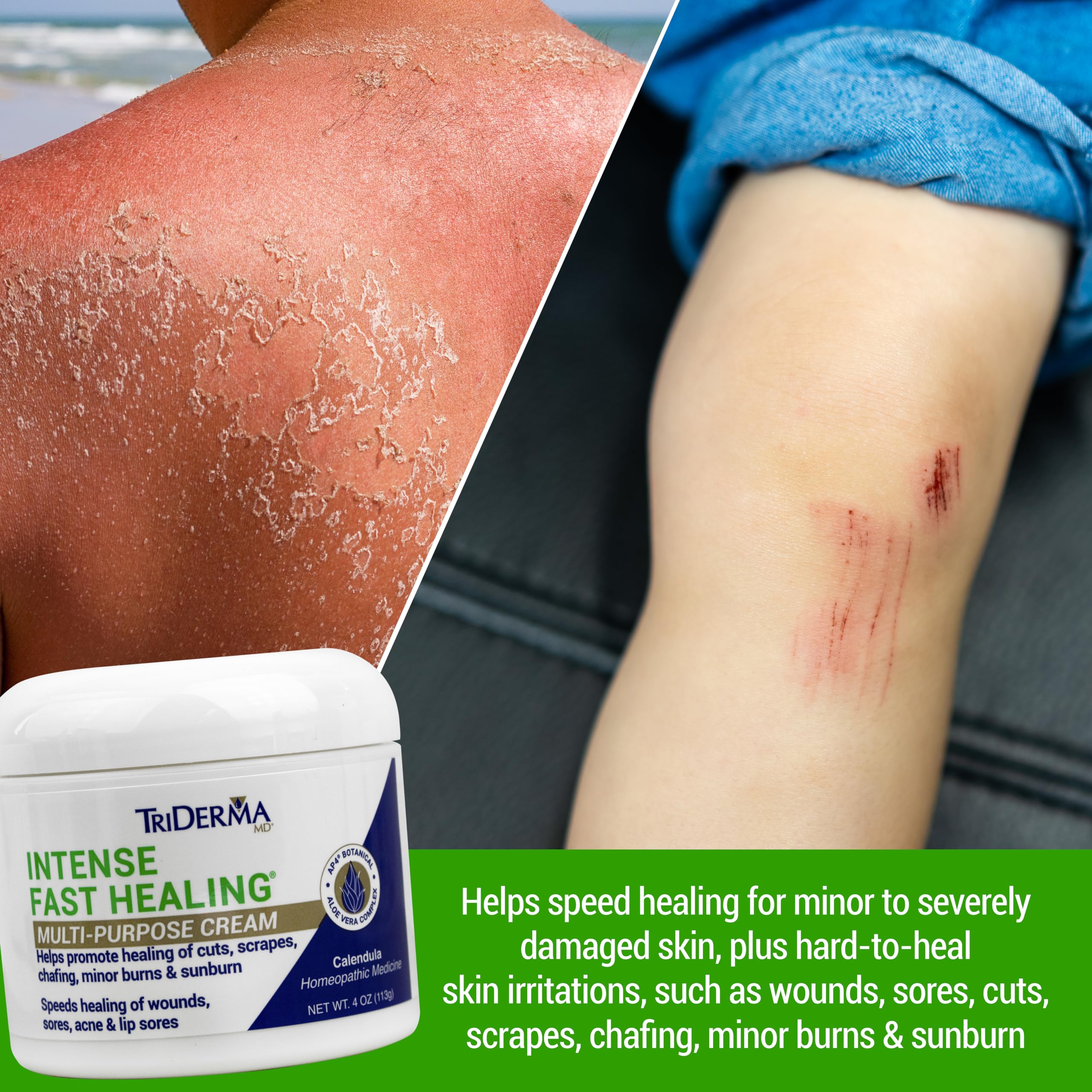 TriDerma Intense Fast Healing Cream – 4 oz for Minor Irritations, Rashes, Scrapes & Cuts