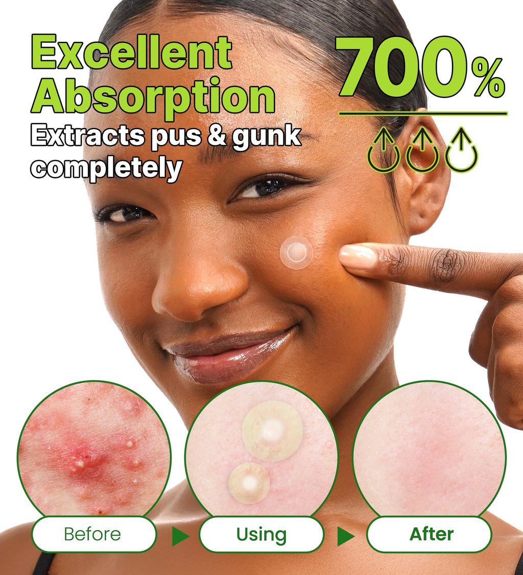 Troubless Invisible Plus Spot Patch The Red Correct – Redness-Targeting Hydrocolloid Patch (96 ea)