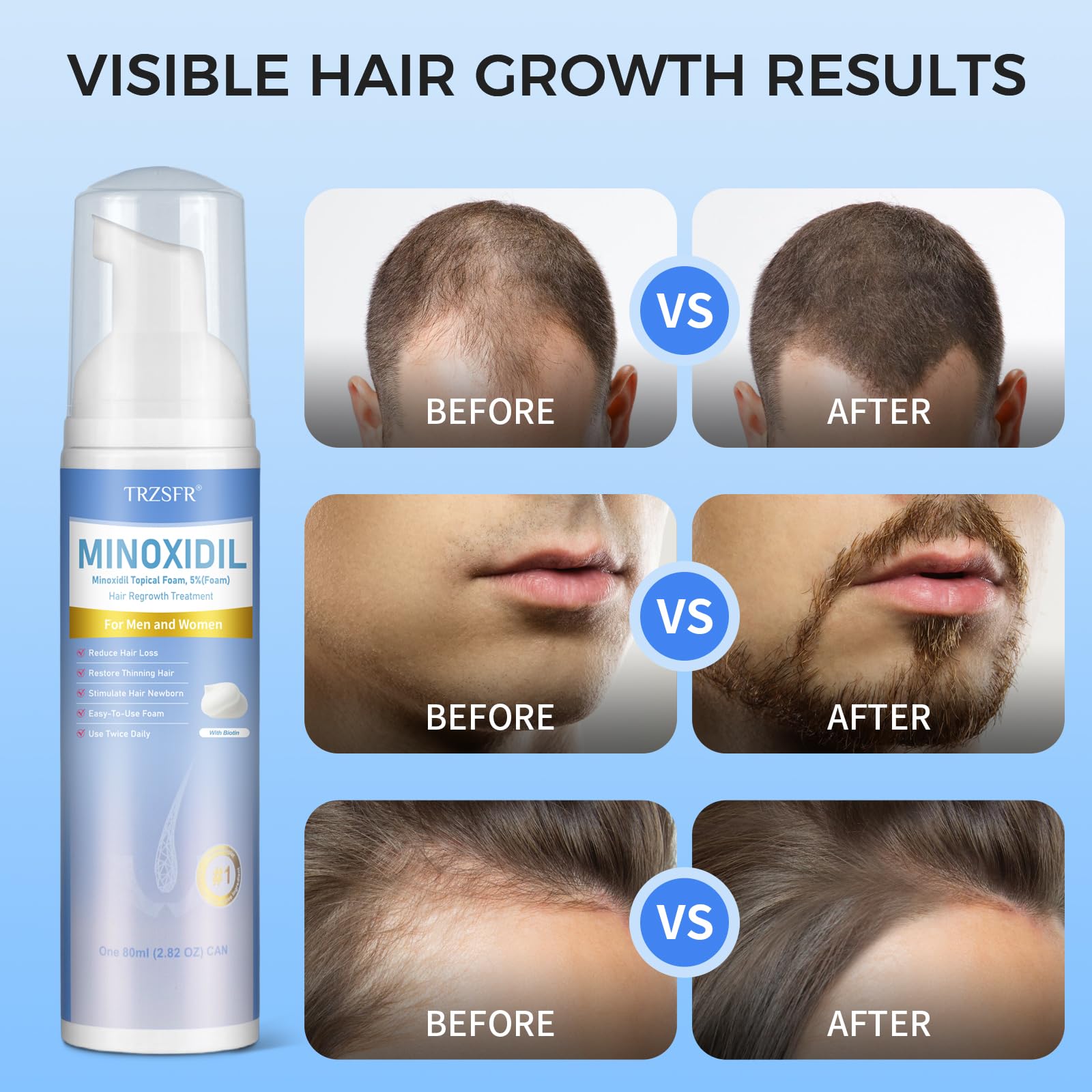 Trzsfr 5% Minoxidil Foam for Men & Women – Hair Regrowth, Non-Greasy, 6-Month Supply (14 oz Total)