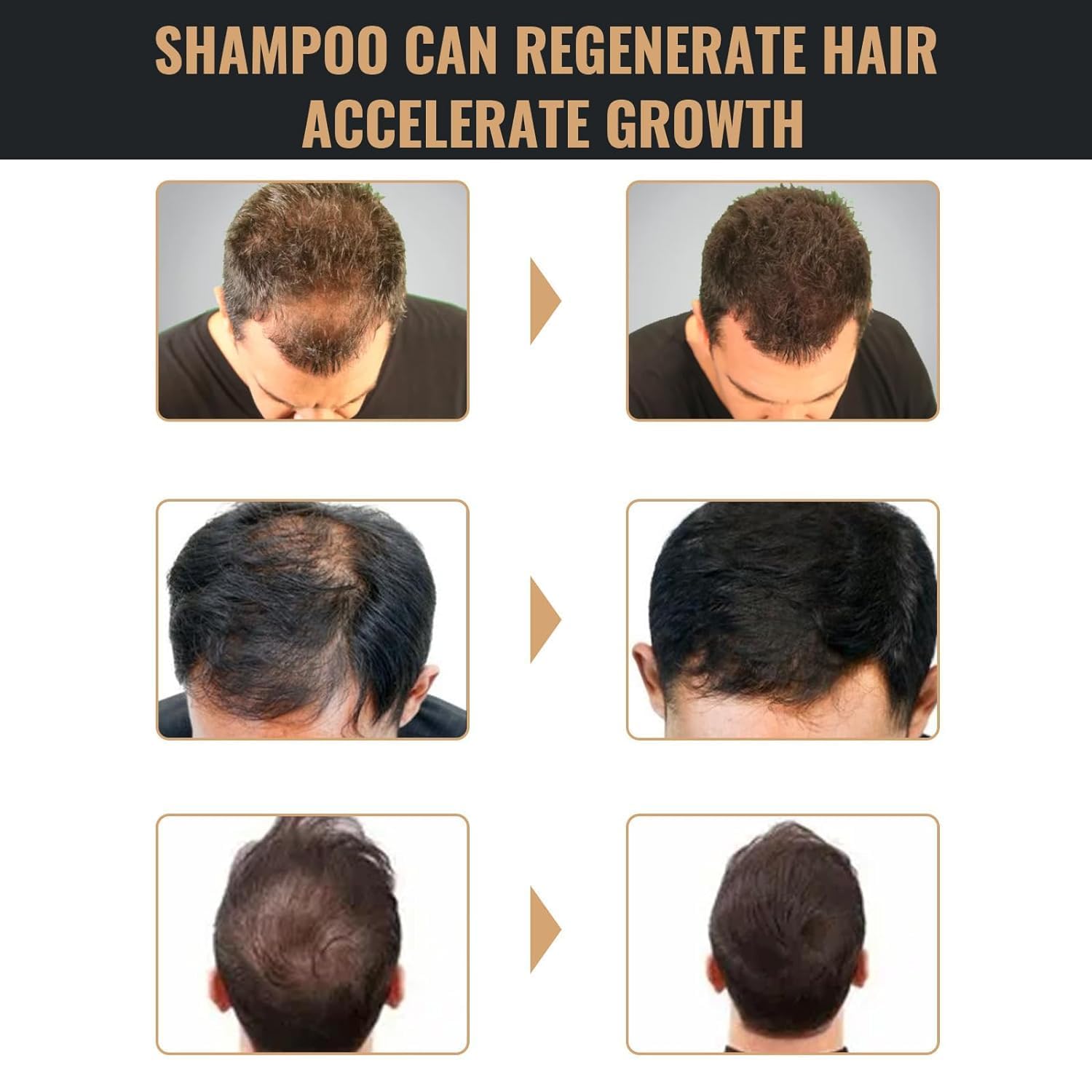 UN UNITEDTIME Root Activator Shampoo – Hair Growth Root Activator for Men & Women (100ml)