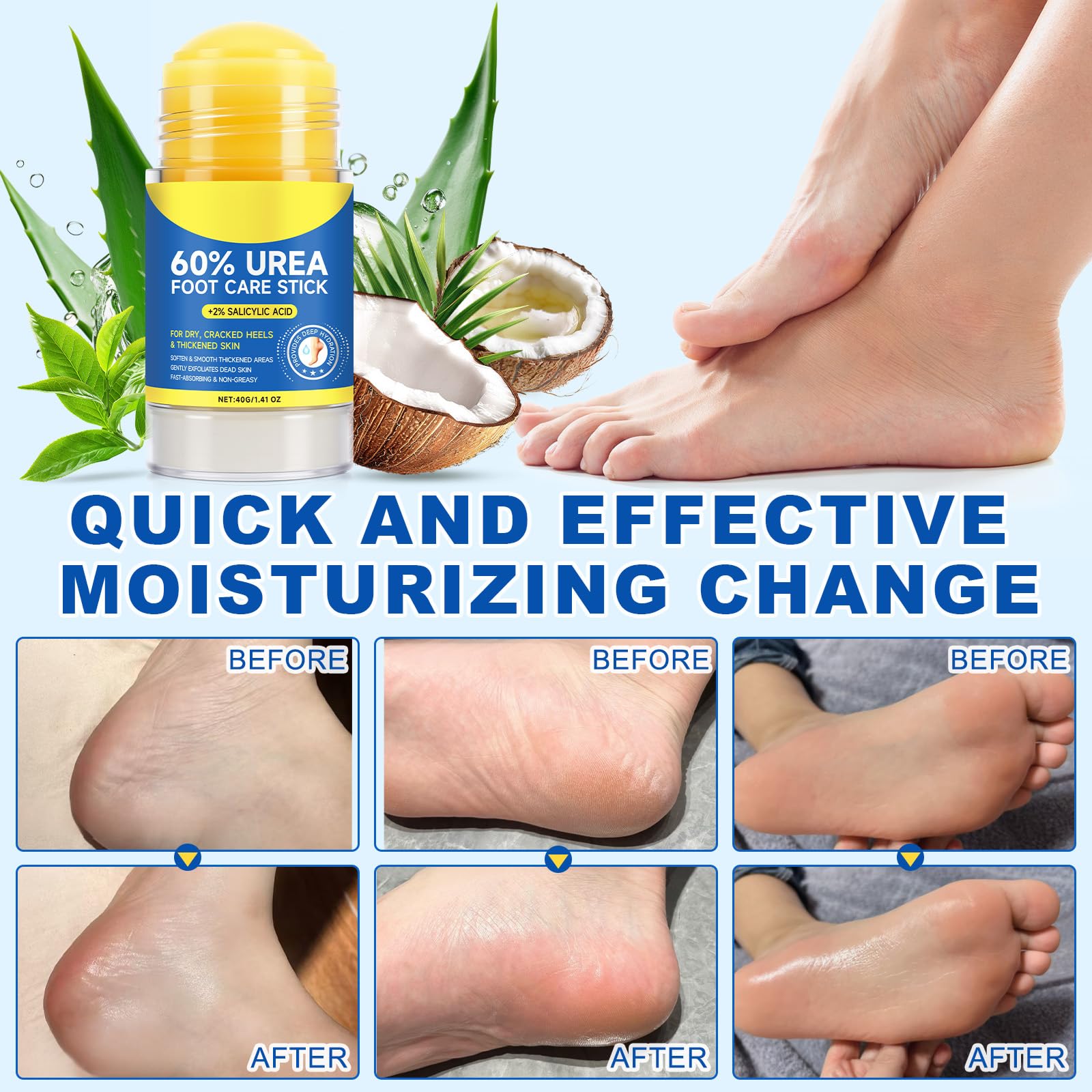 Urea 60% & Salicylic Acid 2% Moisturizing Stick Balm – Callus Softener for Feet & Hands (40g)