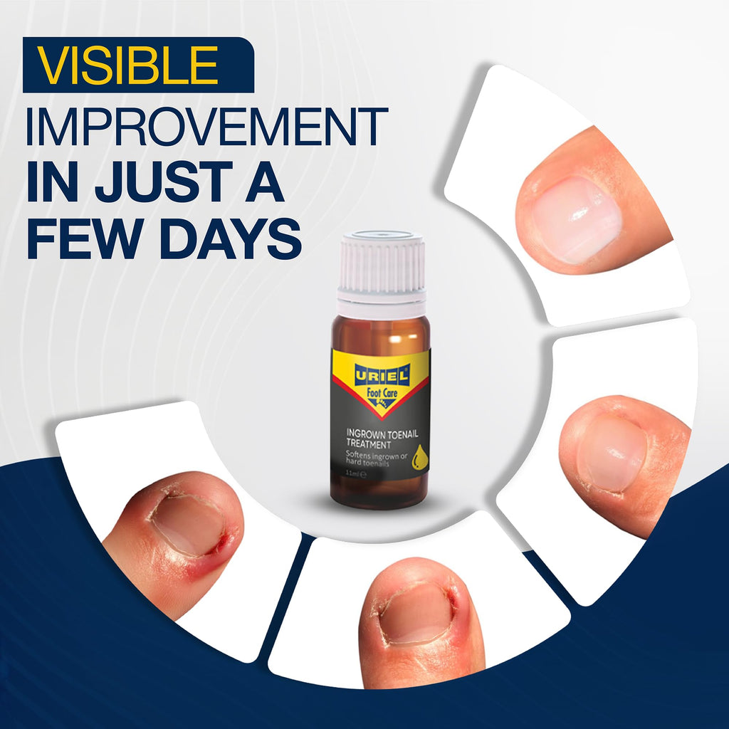 URIEL UPGRADED Ingrown Toenail Treatment with Silicone Caps – Removal Kit & Drops 11 ml
