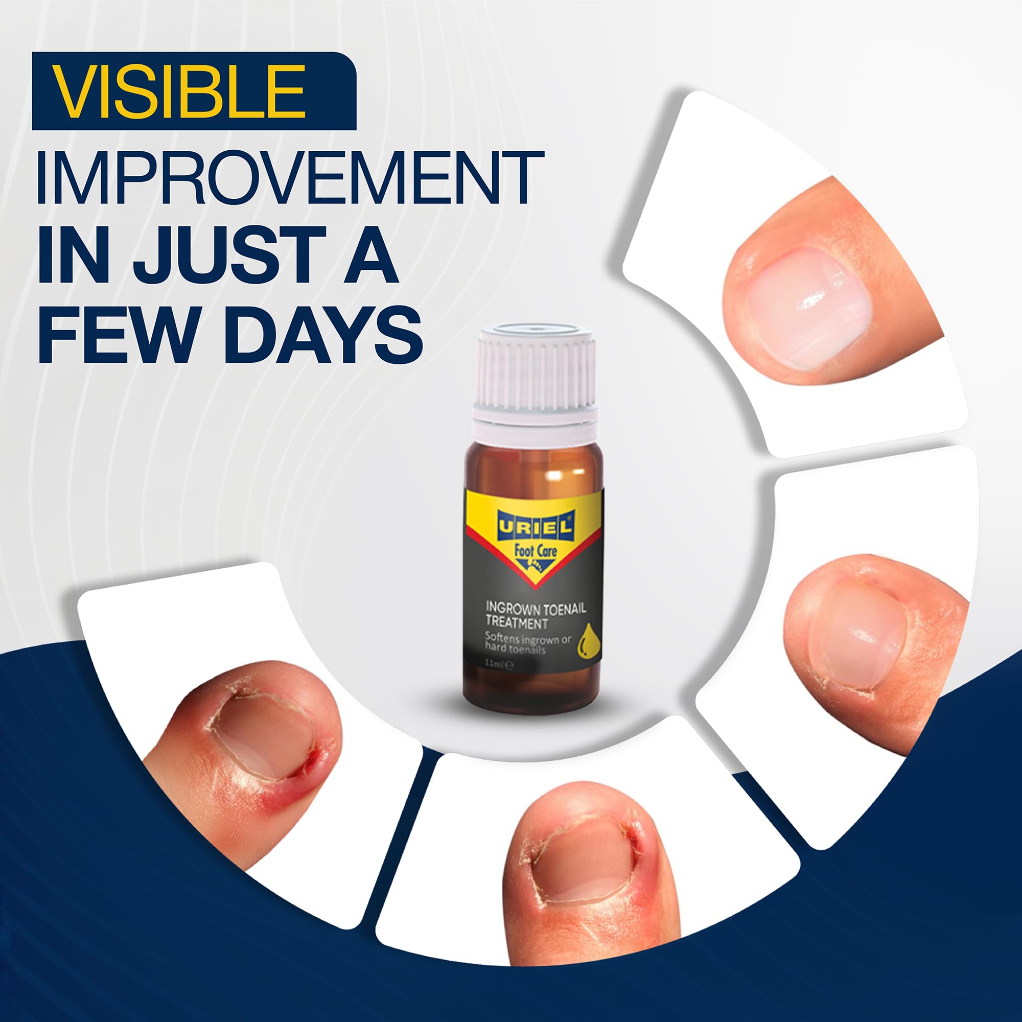 URIEL UPGRADED Ingrown Toenail Treatment with Silicone Caps – Removal Kit & Drops 11 ml
