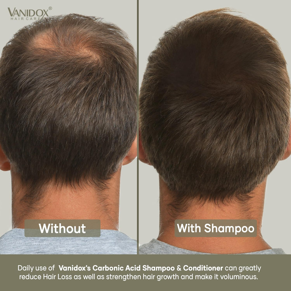 VANIDOX Carbonic Acid Shampoo & Conditioner Set — Deep Moisture, Volume & Scalp Nourishment | Made in USA