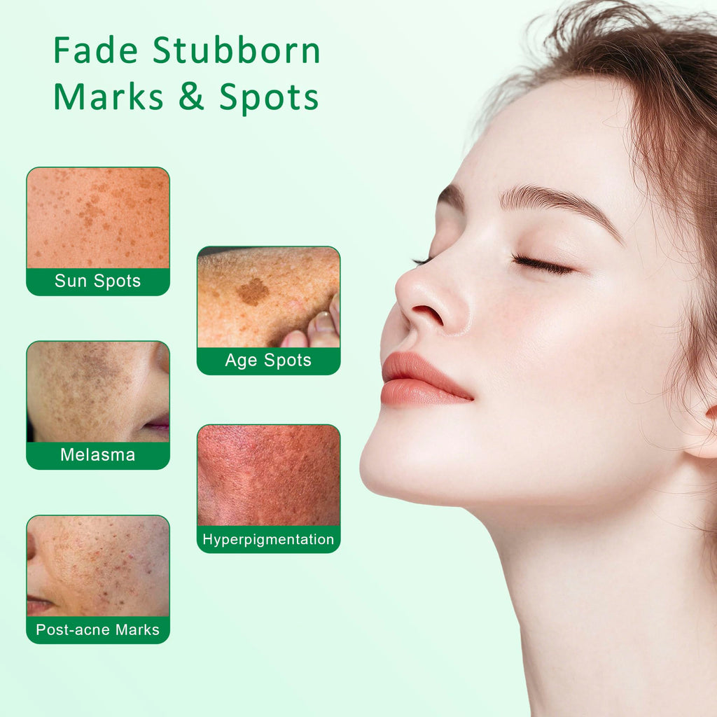 VBBV Dark Spot Remover Serum for Face & Body – Hyperpigmentation & Melasma – 1.7 fl oz