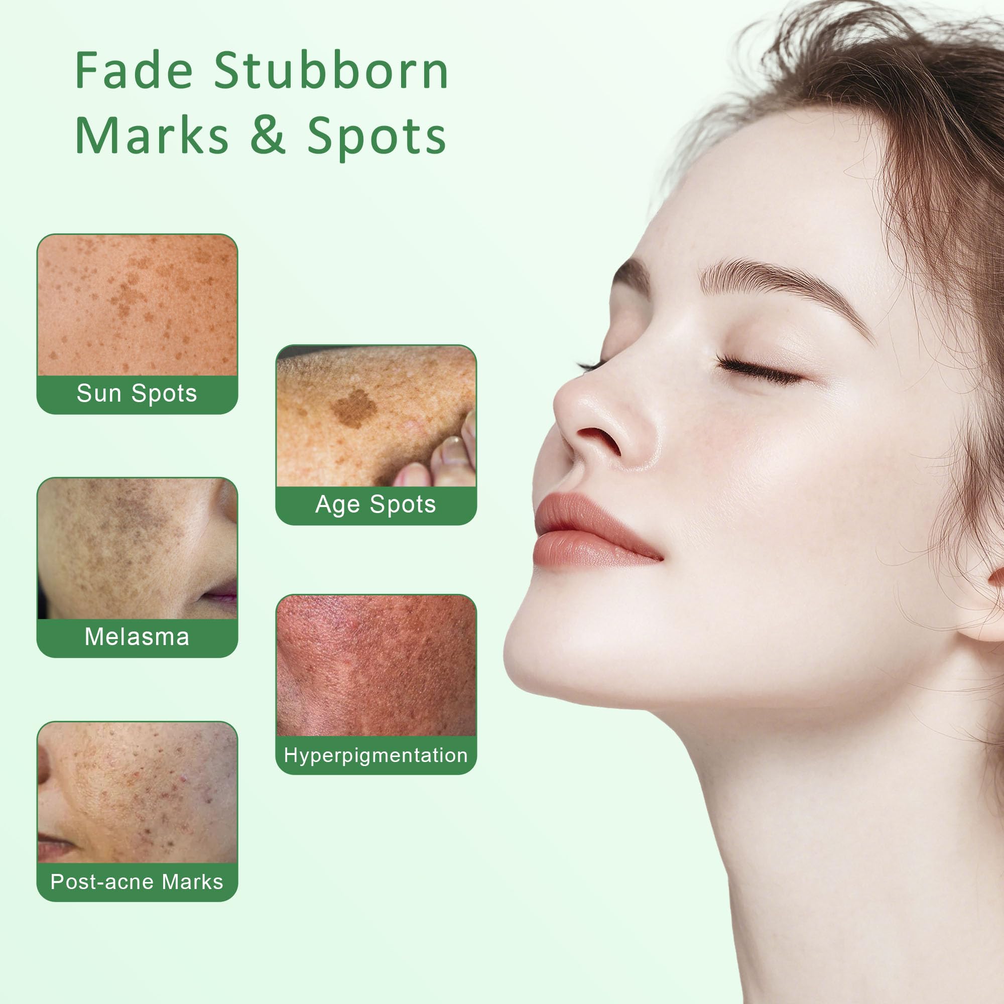 VBBV Dark Spot Remover Serum for Face & Body – Hyperpigmentation & Melasma – 1.7 fl oz