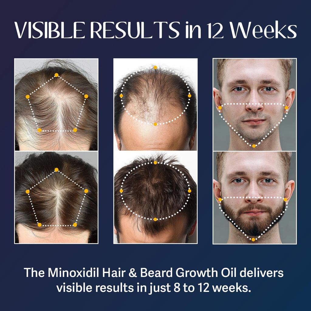 Venanoci 5% Minoxidil Beard Growth Kit with Biotin & Rosemary – Thicker, Fuller Beard