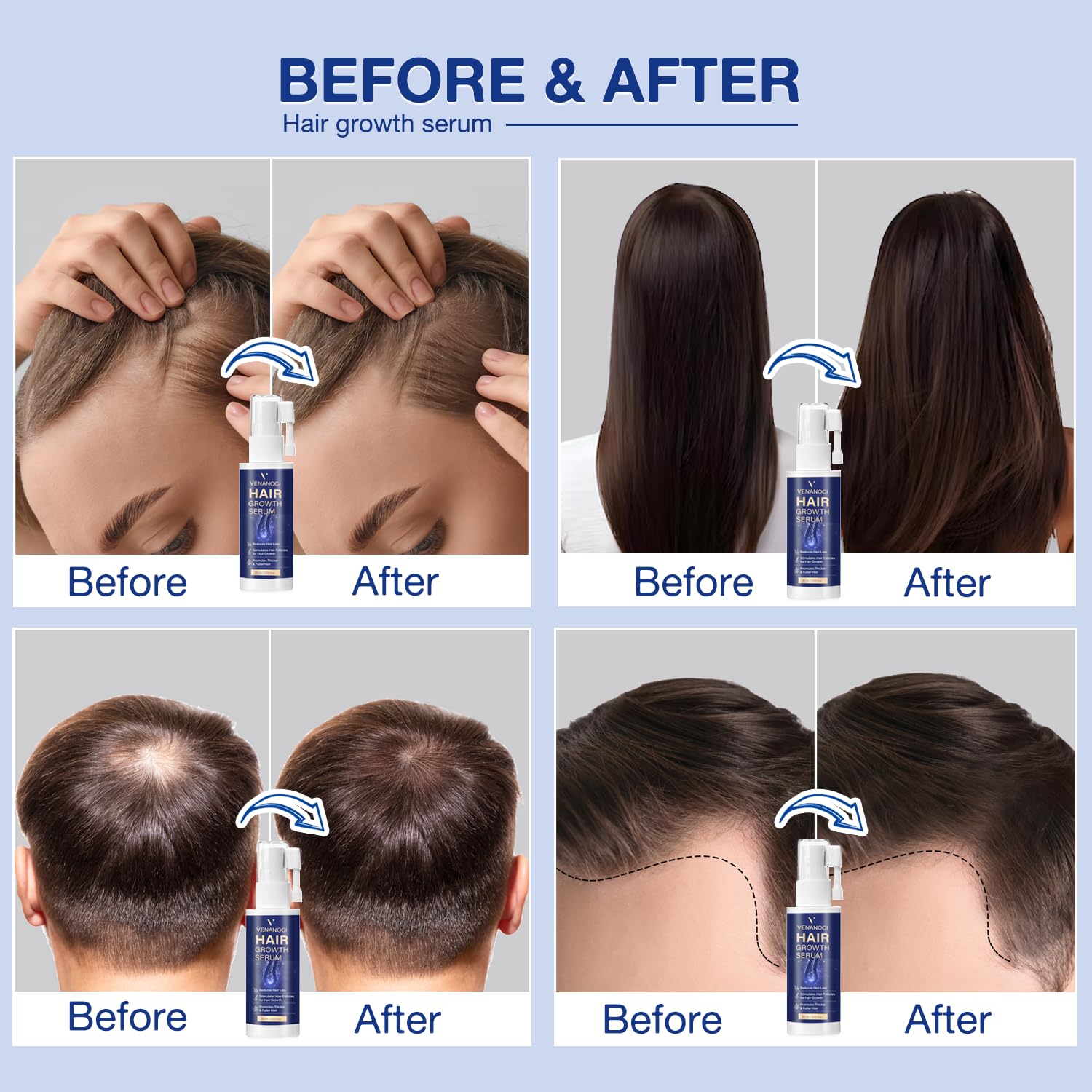 VENANOCI Hair Growth Oil Spray – Natural Regrowth Serum with Rosemary & Biotin for Thinning Hair