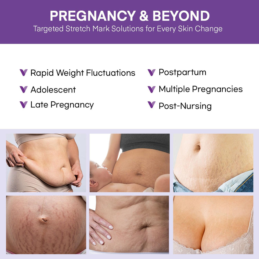 Vigority Stretch Mark Cream for Pregnancy – Belly Butter for Expecting Moms, 4 oz