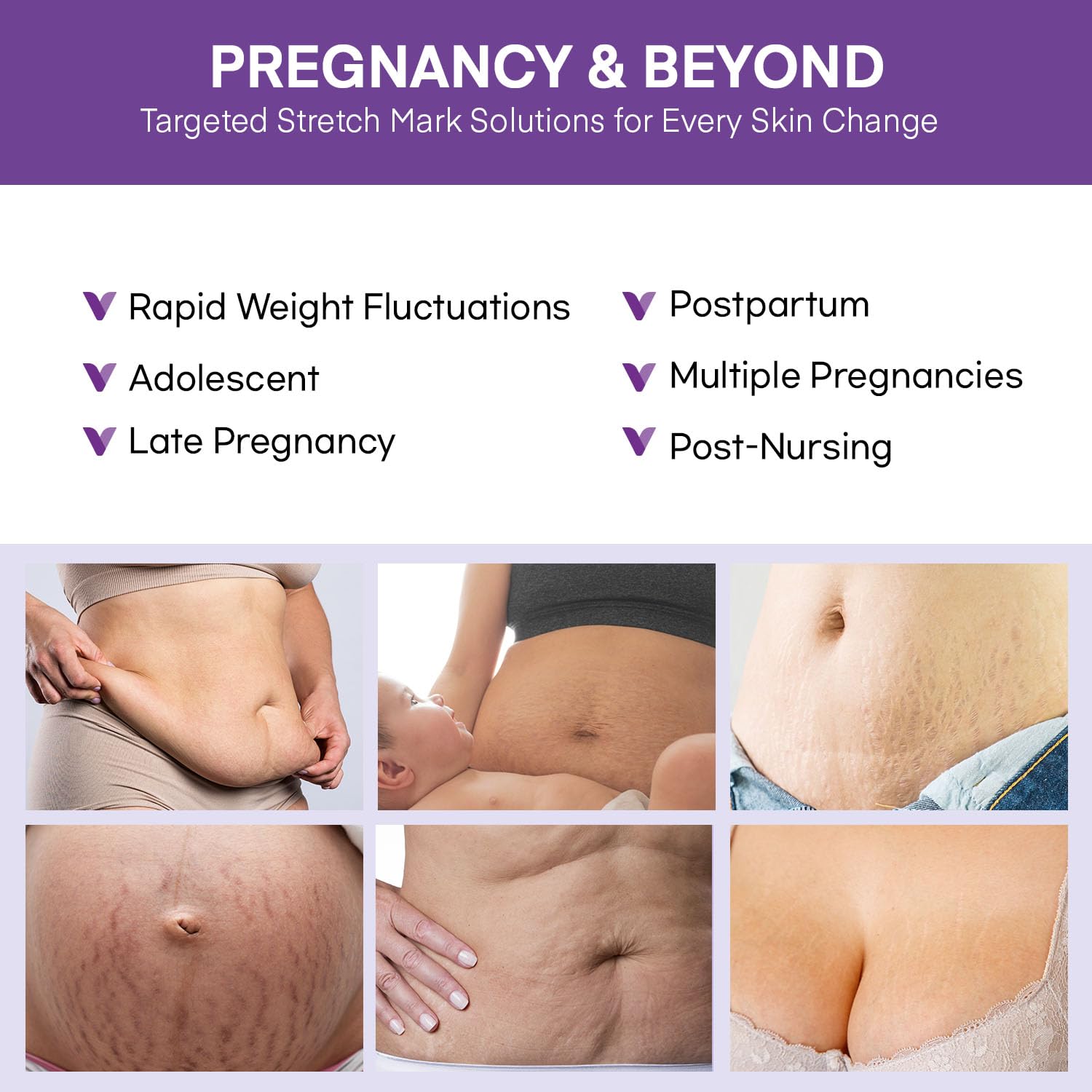 Vigority Stretch Mark Cream for Pregnancy – Belly Butter for Expecting Moms, 4 oz