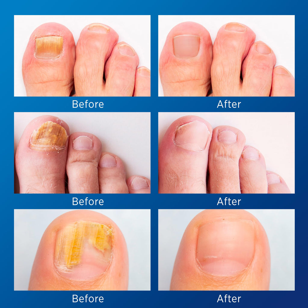 VigorWell Toenail Fungus Treatment Extra Strength – Nighttime Patches & 15ml Nail Repair Liquid (32 Patches)